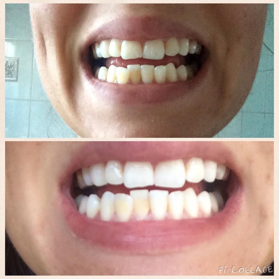 Dentists Pulled Out More Than 500 Teeth From a 7-Year-Old Boy’s Mouth