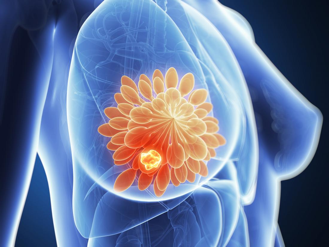 Business corridor-of-famer thriving through breast cancer 1
