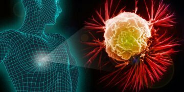 OS Benefit With Ribociclib Seen Across HR+/HER2- Breast Cancer Settings