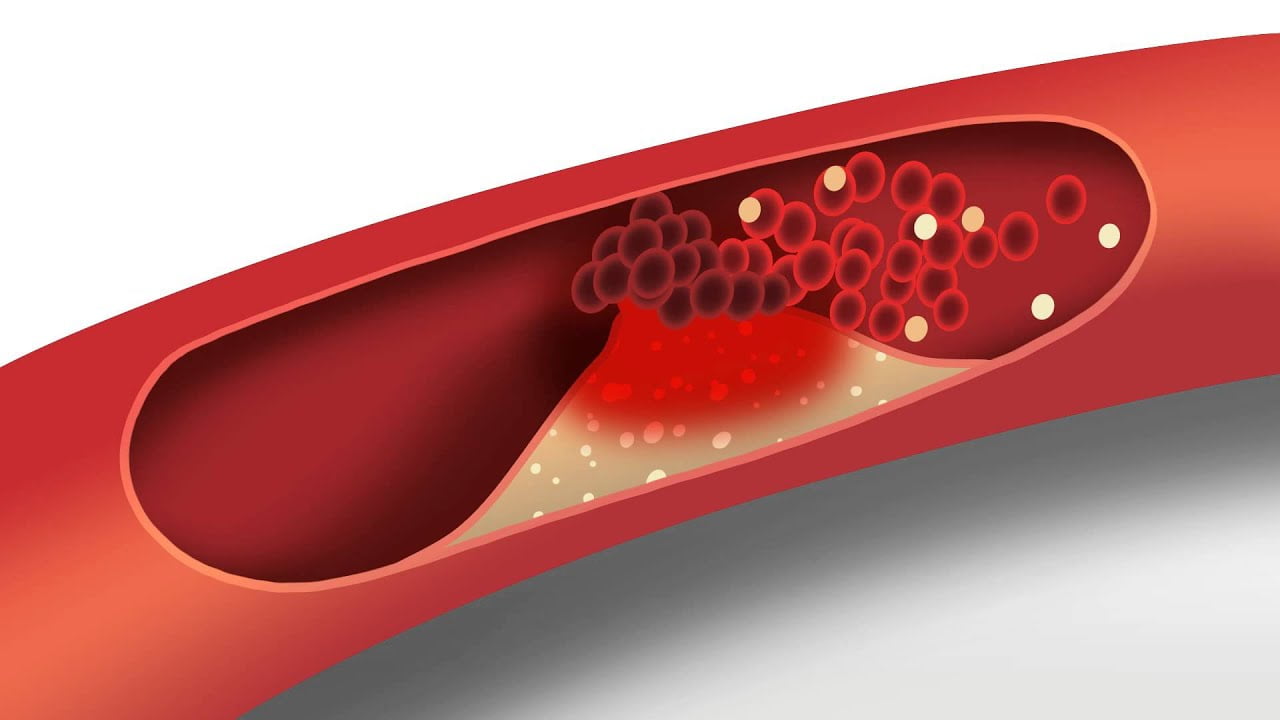Glowing Cholesterol Gives Scientists a Glimpse of How to Fight Heart Disease