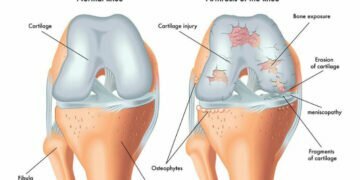 Treat Knee Pain Going Down Stairs Now